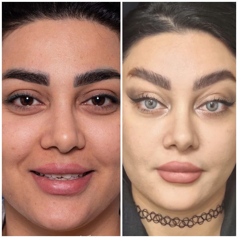 جراحی لیفت آندوسکوپیک