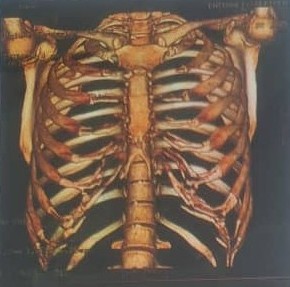 سی تی اسکن جدار قفسه سینه برای انتخاب غضروف دنده