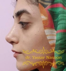 جراحی بینی طبیعی