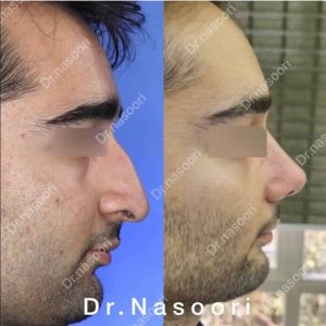 جراحی بینی طبیعی مردانه