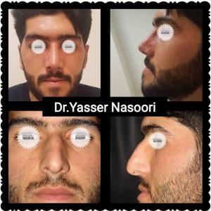 جراحی بینی طبیعی مردانه