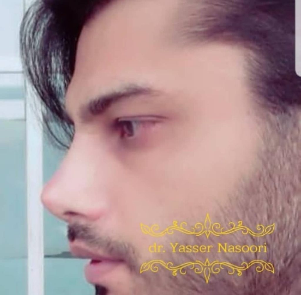 جراحی بینی طبیعی