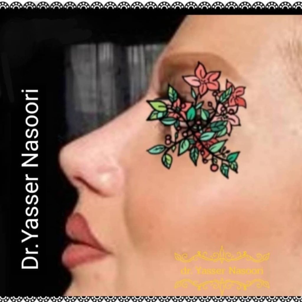 جراحی بینی طبیعی