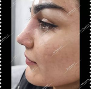 جراحی بینی طبیعی