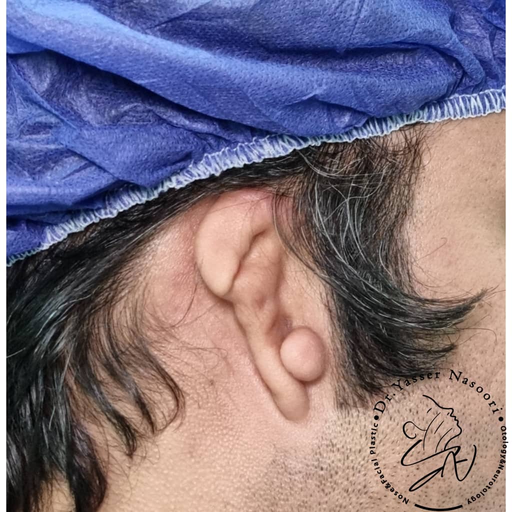 بازسازی لاله گوش