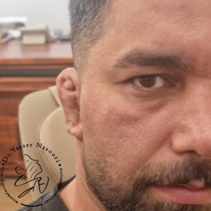 بازسازی لاله گوش