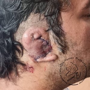 بازسازی لاله گوش