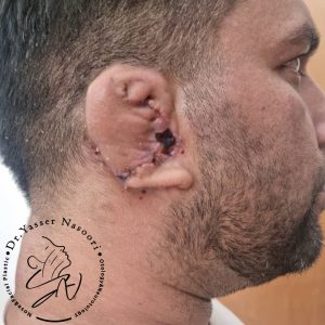 بازسازی لاله گوش