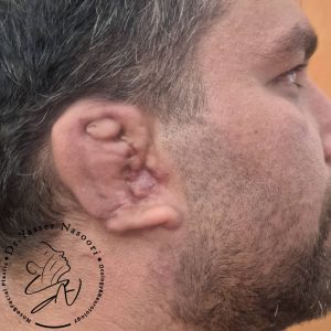 بازسازی لاله گوش