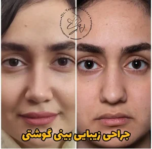 جراحی بینی گوشتی