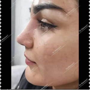 جراحی بینی گوشتی