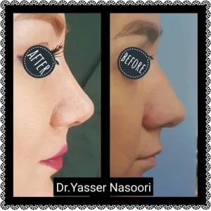 جراحی بینی گوشتی
