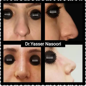 جراحی بینی گوشتی