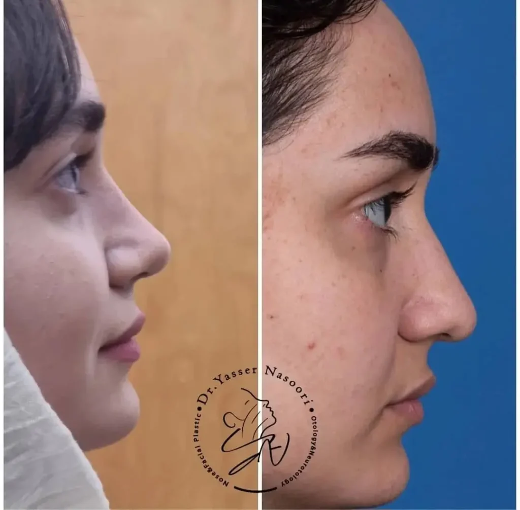 جراحی بینی گوشتی
