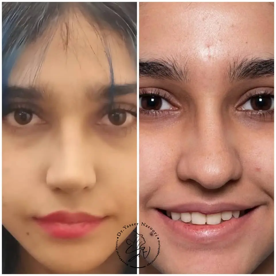 جراحی بینی گوشتی