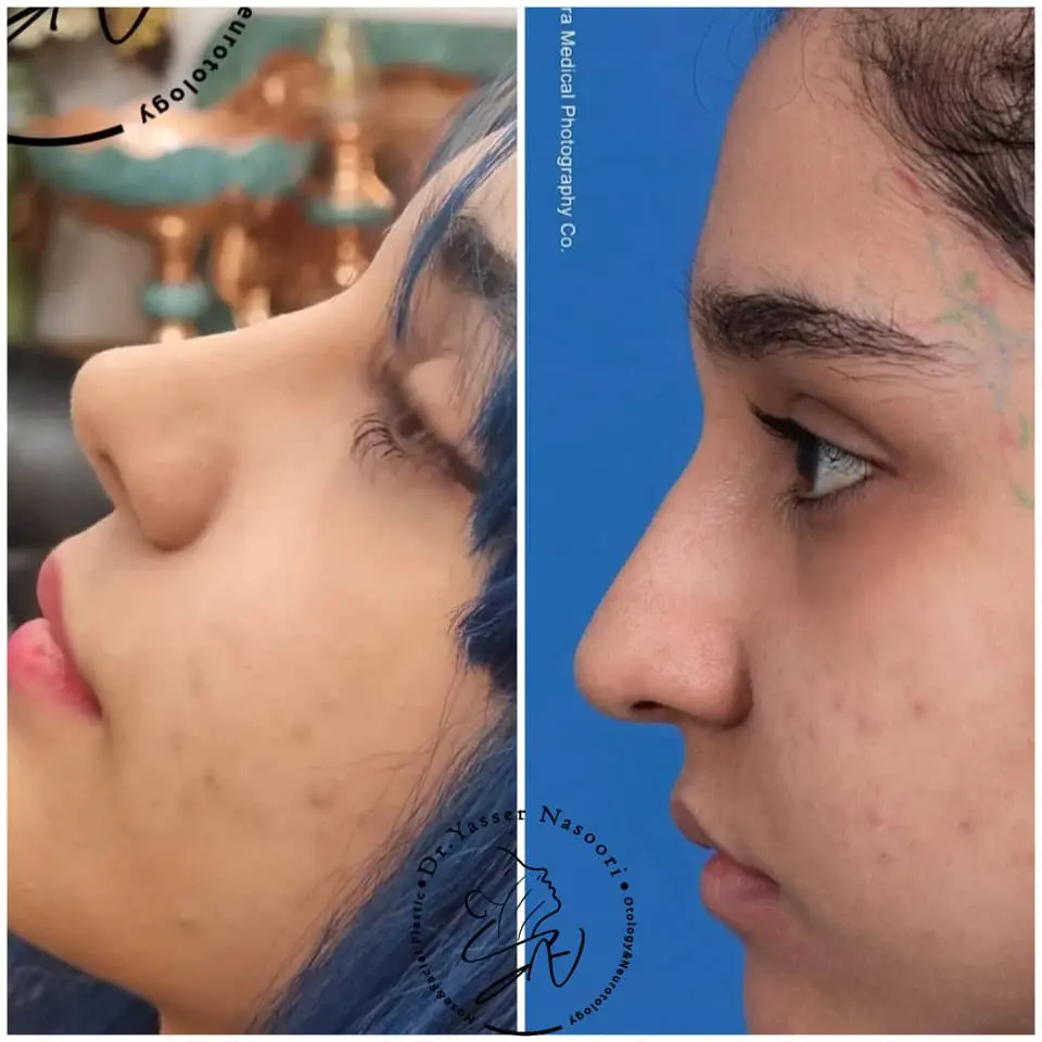جراحی بینی گوشتی