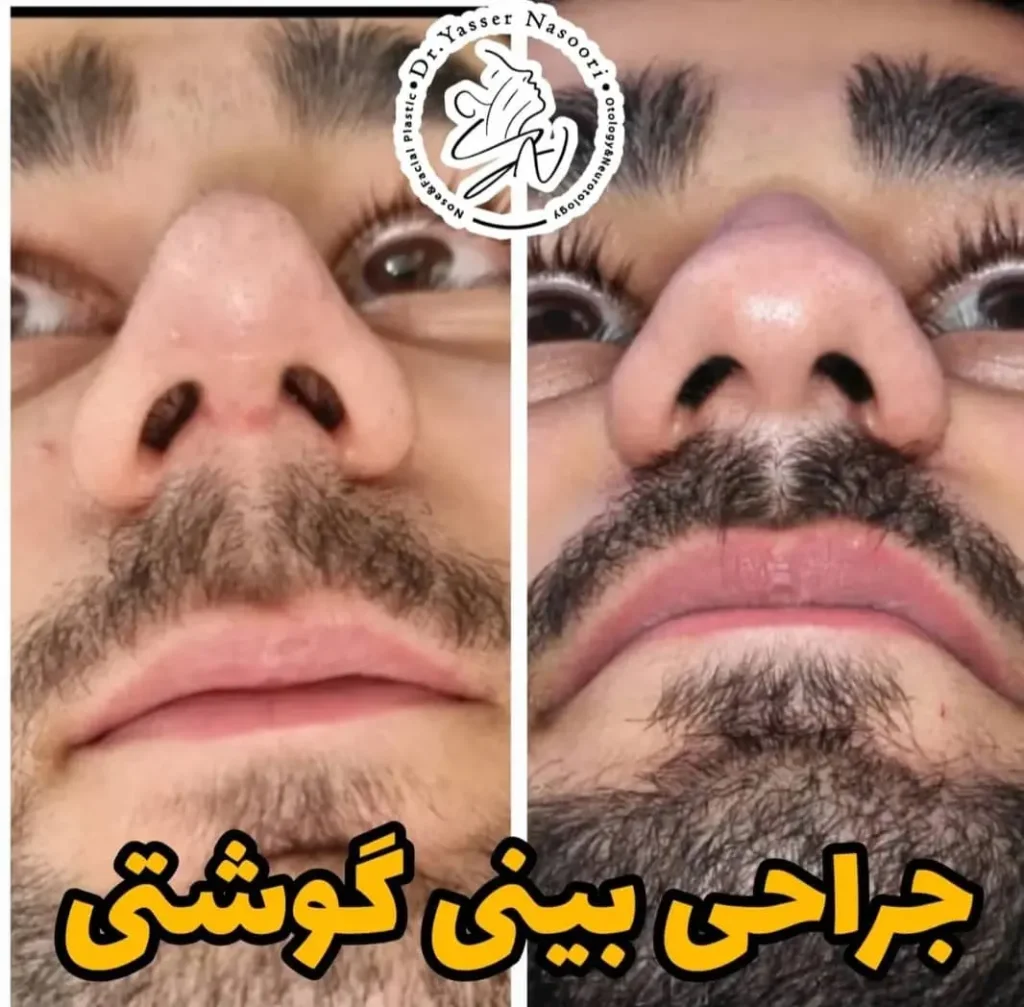 جراحی بینی گوشتی