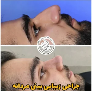 جراحی بینی گوشتی