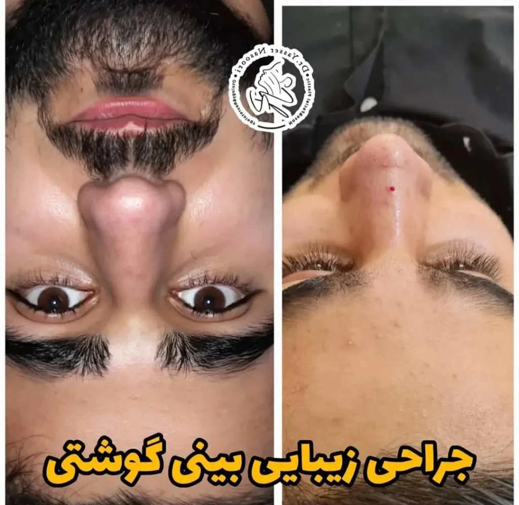 جراحی بینی گوشتی