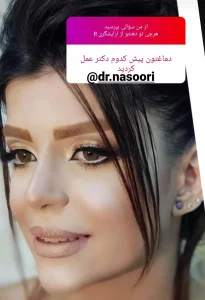 جراحی بینی نیمه فانتزی