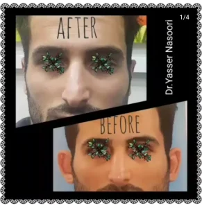 جراحی زیبایی گوش (اتوپلاستی)