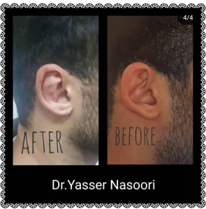 جراحی زیبایی گوش (اتوپلاستی)