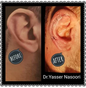 جراحی زیبایی گوش (اتوپلاستی)