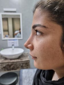 جراحی زیبایی بینی