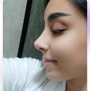 جراحی زیبایی بینی