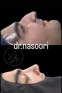 جراحی زیبایی بینی