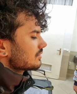 جراحی زیبایی بینی