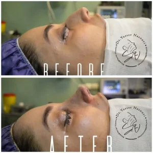 جراحی زیبایی بینی