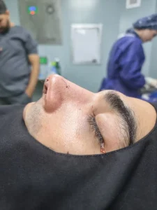 جراحی زیبایی بینی