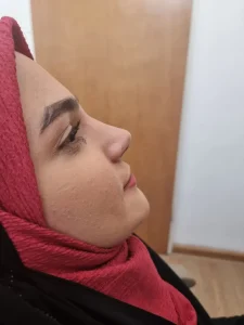 جراحی زیبایی بینی