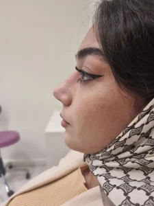 جراحی زیبایی بینی